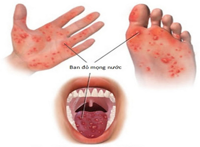 3 dấu hiệu cảnh báo bệnh tay chân miệng ở giai đoạn nặng cần nhập viện