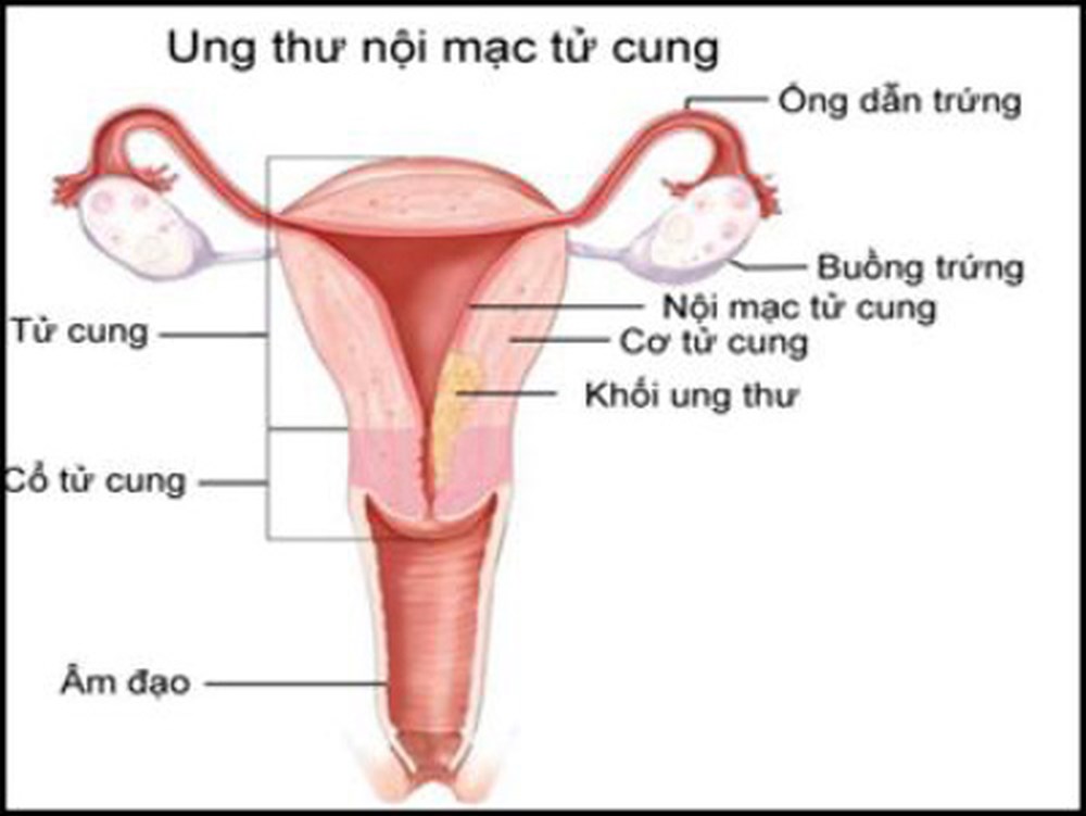 Chi tiết những giai đoạn phát triển của ung thư nội mạc tử cung
